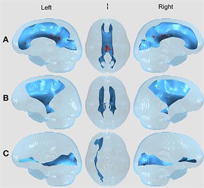 White matter tract changes in pediatric posterior fossa brain tumor survivors after surgery and chemotherapy